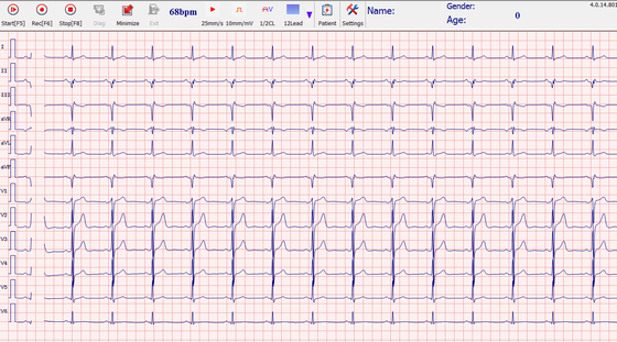White and grey Pc-based Ecg With Monior CV200 128MB RAM  USB connection